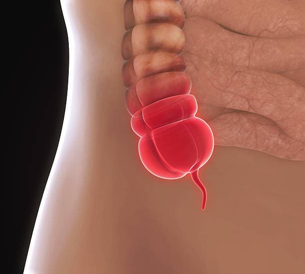 Appendicitis Diagnosis Overview
