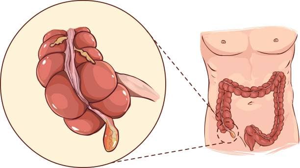 Diagram of appendix inflammation for appendicitis in children
