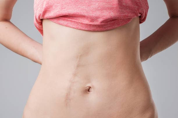 Appendicitis Surgery Illustration