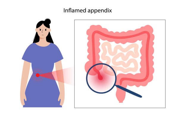 Appendicitis Recovery Tips