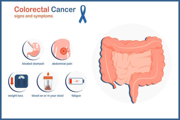 Symptoms of Colorectal Cancer Infographic