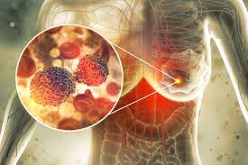 Overview of common breast cancer symptoms for early detection and awareness