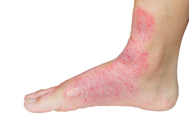 Early Signs of Lupus Illustration