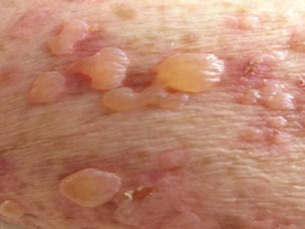 Lupus Skin Rash Example