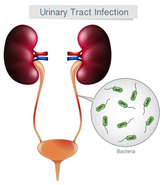 UTI causes diagram