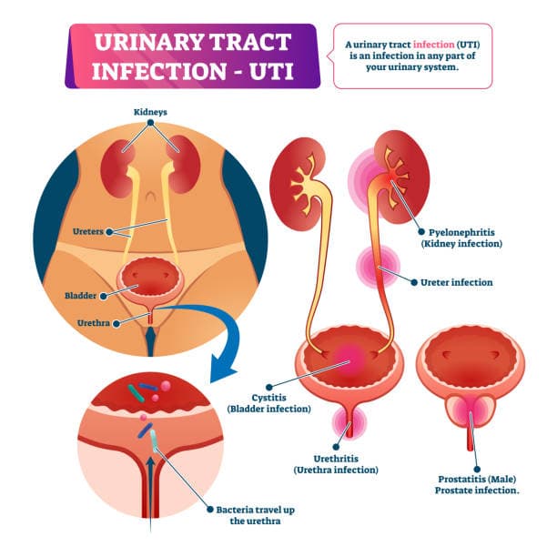 UTI risk factors infographic