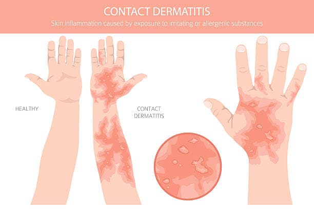 Image of environmental eczema triggers