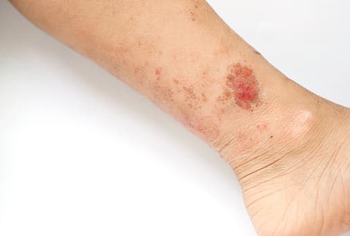 Hero image of eczema skin