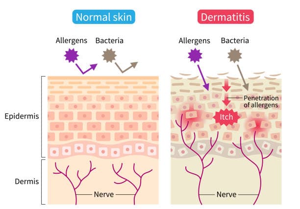 Image explaining eczema prevention