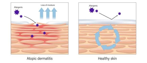Comparative Image of Eczema Cream Types