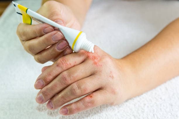 Application of the best eczema cream for effective skin relief
