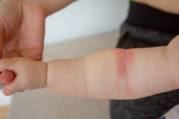 Child with eczema on arm