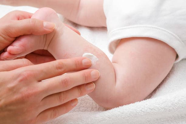Eczema treatment for kids