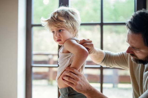 Eczema triggers in kids