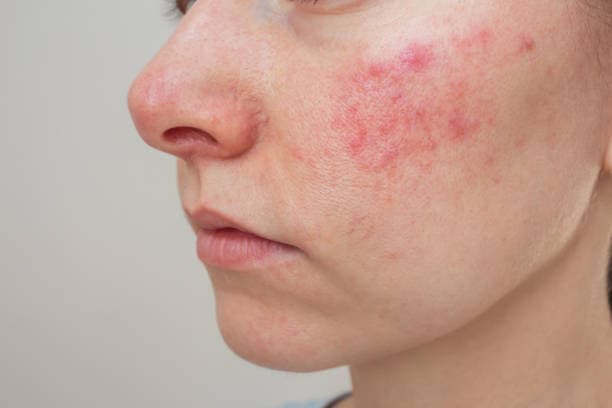 Eczema on Face Example