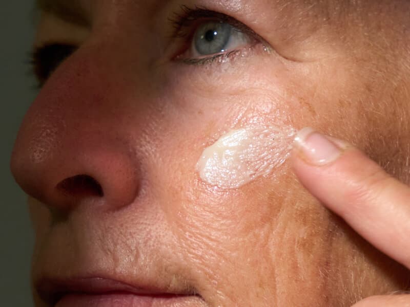 Eczema Treatment Options