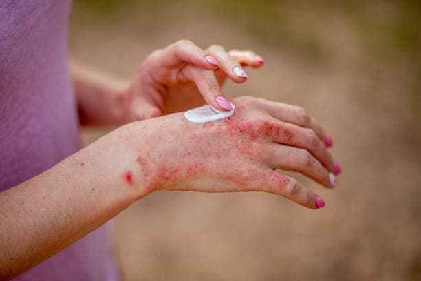 Eczema on Hands Management Tips