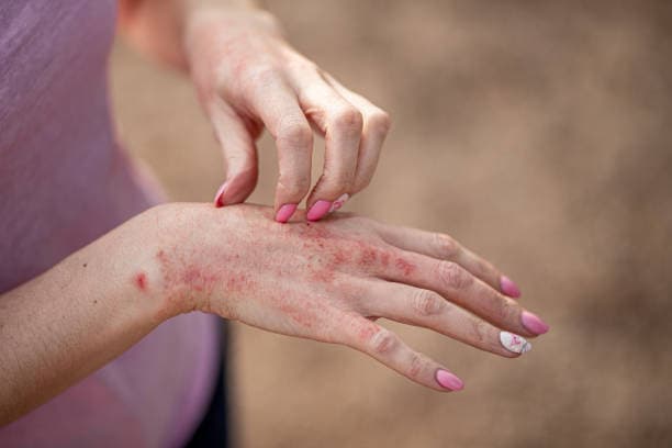 Eczema on Hands Overview