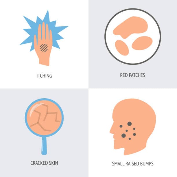 Common eczema symptoms