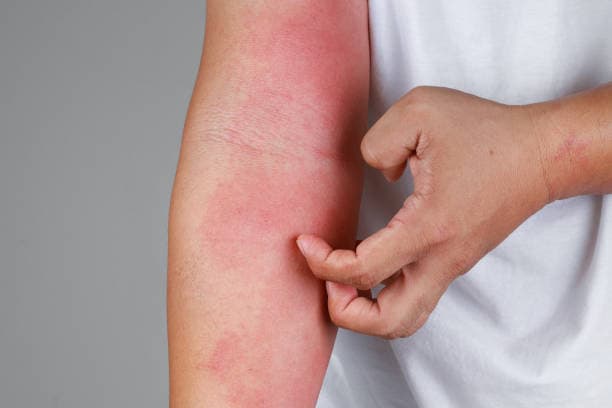 Eczema symptoms: Red and itchy skin patches on arms