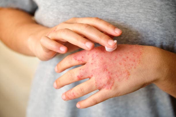 Applying eczema cream