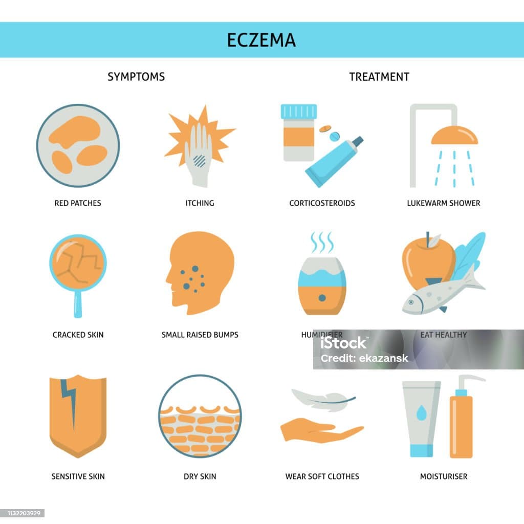 Effective eczema treatment options including creams and natural remedies