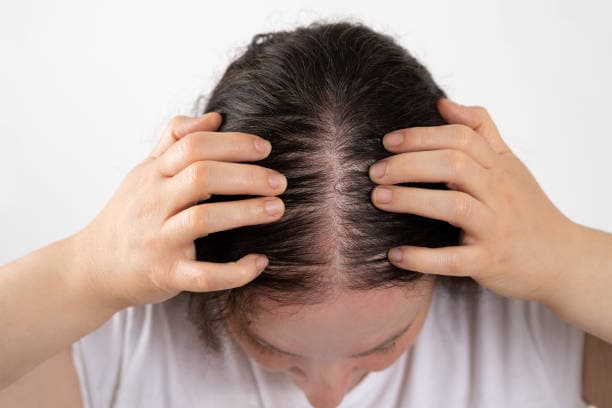 Causes of Menopausal Hair Loss