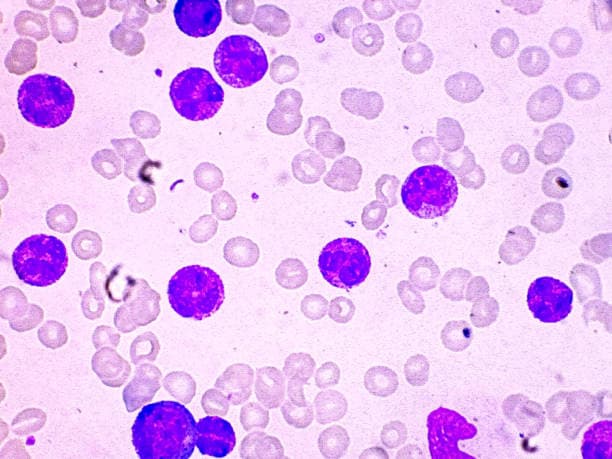 Leukemia Diagnosis and Treatment