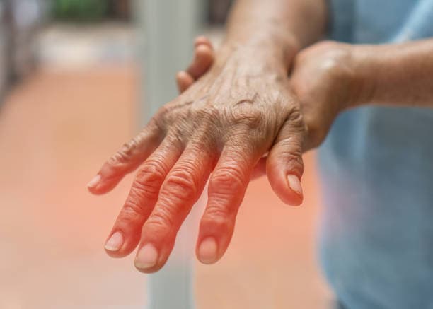 Symptoms of Lupus and Joint Pain