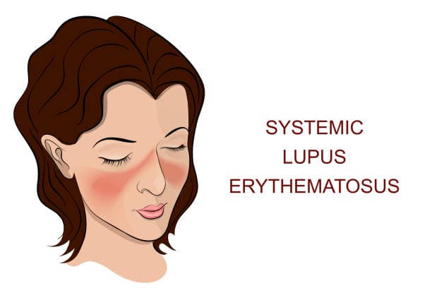 Lupus Fatigue Hero Image