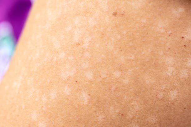 Lupus Rash Symptoms Overview