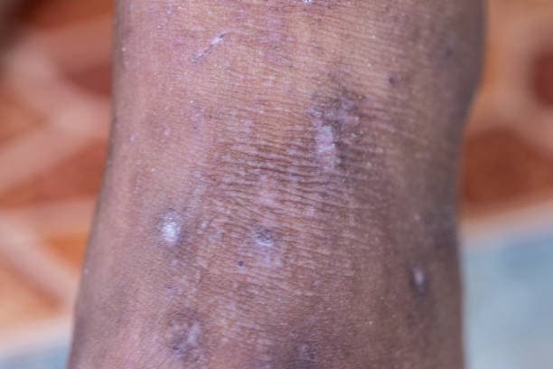 Types of Lupus Rashes
