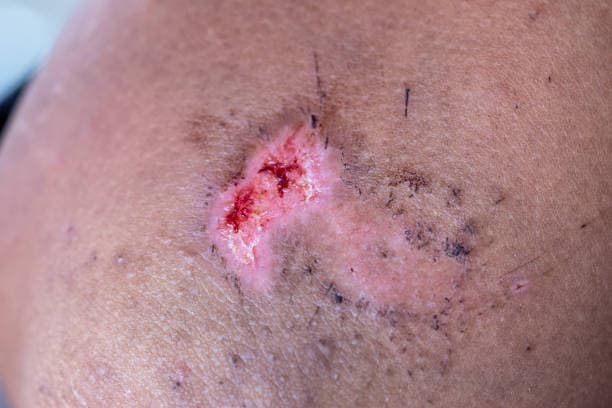 Image of common lupus rashes