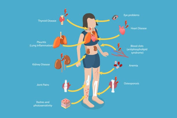 Lupus organ symptoms diagram