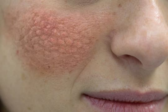 Lupus skin symptoms illustration