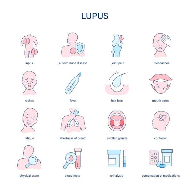 Lupus Diagnosis Process
