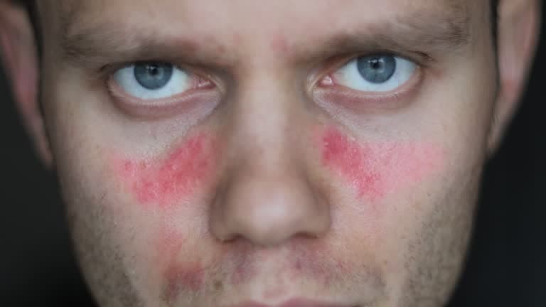 Lupus Symptoms in Men Overview