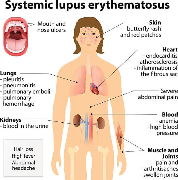 Illustration of common lupus symptoms in women