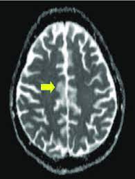 Lupus brain scan