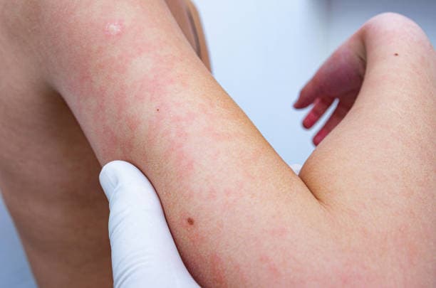 Norovirus Rash Symptoms Overview