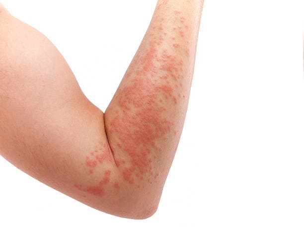 Norovirus Skin Rash Example