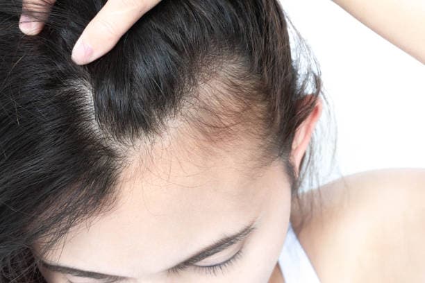 Nutrient Deficiencies and Hair Loss Infographic