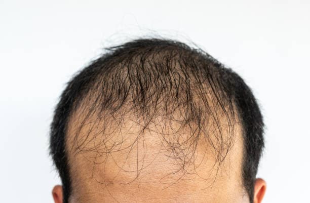Illustration of nutrient deficiency hair loss showing thinning hair and nutrient-rich foods