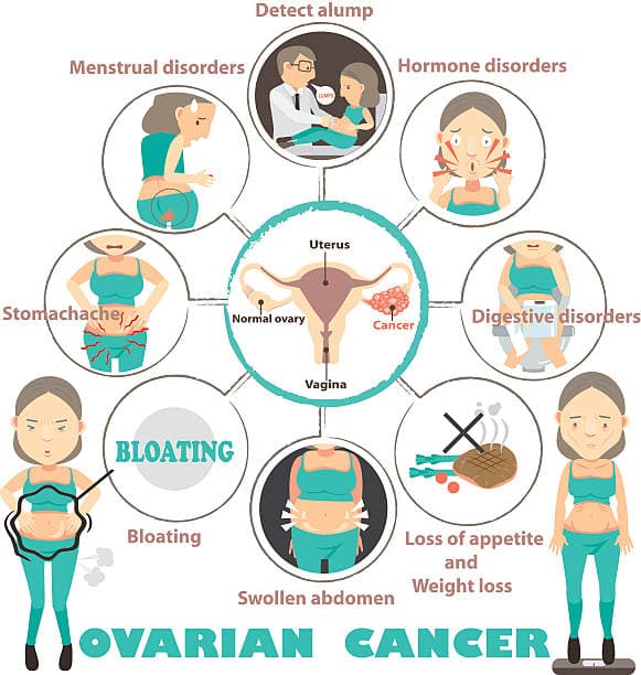 Checklist of ovarian cancer symptoms infographic