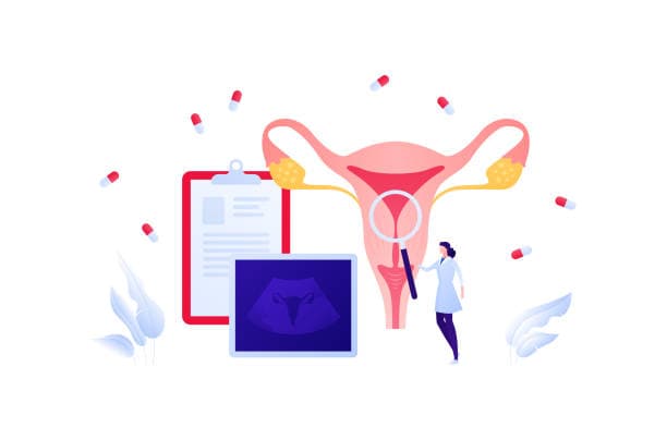 Ovarian cancer treatment options illustration