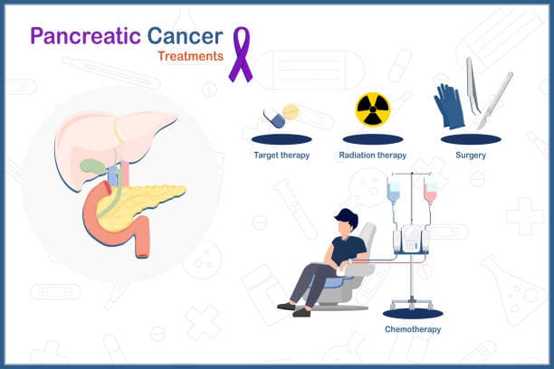 Pancreatic Cancer Diagnosis Process