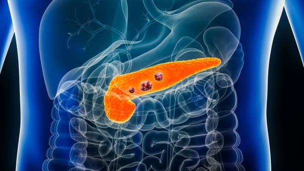 Early signs of pancreatic cancer awareness illustration