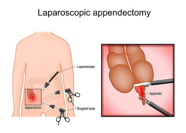 Appendicitis Surgery Procedure