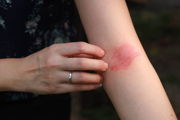 Eczema Rash Comparison