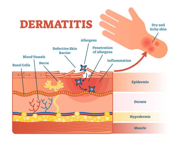 Eczema Treatment Diagram